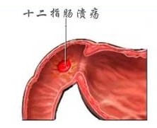 十二指膓燚的症状及治疗