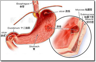 如何确诊十二指肠球部溃疡a1期?
