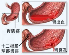 糜烂性十二指肠球炎的症状有哪些?怎么治疗