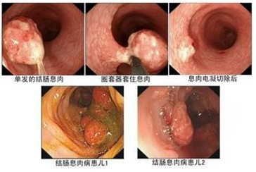 结肠息肉的类型