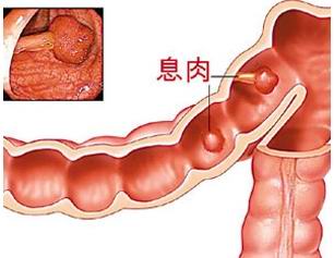 肠息肉佳治疗方法