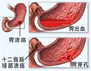 胃出血怎么办