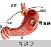 胃溃疡